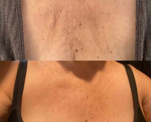 Microneedling: vorher / nacher Microneedling: vorher / nacher