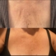 Microneedling: vorher / nacher Microneedling: vorher / nacher