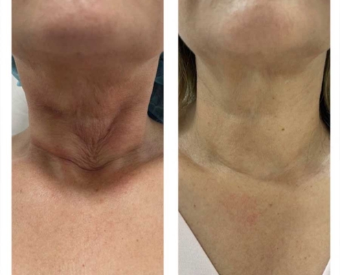 Microneedling: vorher / nacher Microneedling: vorher / nacher