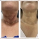 Microneedling: vorher / nacher Microneedling: vorher / nacher