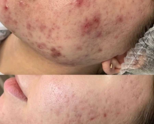 Microneedling: vorher / nacher Microneedling: vorher / nacher