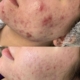 Microneedling: vorher / nacher Microneedling: vorher / nacher