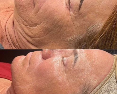 Microneedling: vorher / nacher Microneedling: vorher / nacher