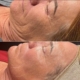 Microneedling: vorher / nacher Microneedling: vorher / nacher