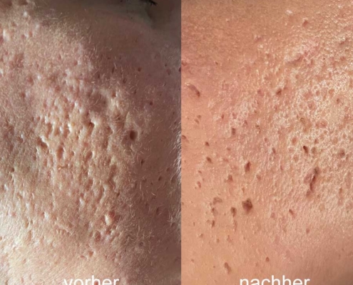 Microneedling: vorher / nacher Microneedling: vorher / nacher
