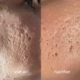 Microneedling: vorher / nacher Microneedling: vorher / nacher