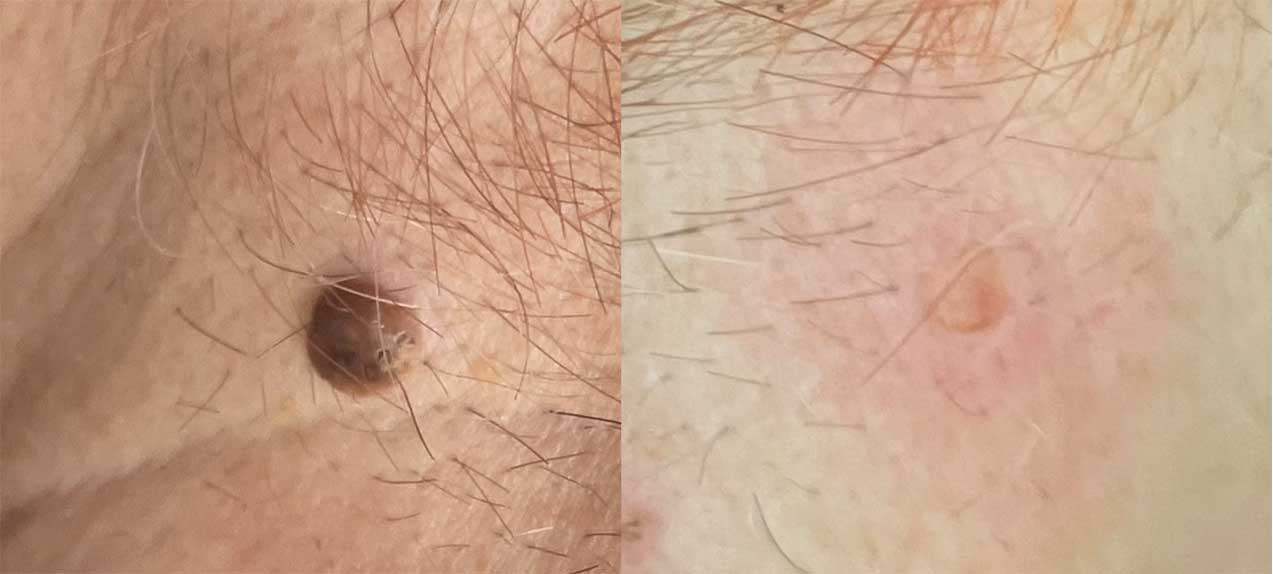 Fibrome und Skintags – Entfernung durch Verdampfung Fibrome und Skintags – Entfernung durch Verdampfung